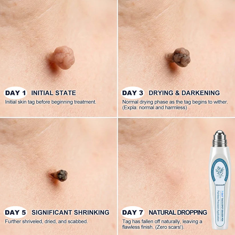 𝐎𝐟𝐟𝐢𝐜𝐢𝐚𝐥 𝐁𝐫𝐚𝐧𝐝 𝐒𝐭𝐨𝐫𝐞 |✅💎Sylvancove® 7-𝐷𝑎𝑦 𝗧𝐚𝐠 & 𝗦𝗽𝐨𝐭 𝐄𝐫𝒂𝒔𝒆𝒓(Zero Pain, Zero 𝐒𝐜𝐚𝒓𝒔 Rollerball)
