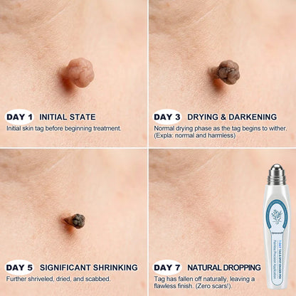 𝐎𝐟𝐟𝐢𝐜𝐢𝐚𝐥 𝐁𝐫𝐚𝐧𝐝 𝐒𝐭𝐨𝐫𝐞 |✅💎Sylvancove® 7-𝐷𝑎𝑦 𝗧𝐚𝐠 & 𝗦𝗽𝐨𝐭 𝐄𝐫𝒂𝒔𝒆𝒓(Zero Pain, Zero 𝐒𝐜𝐚𝒓𝒔 Rollerball)